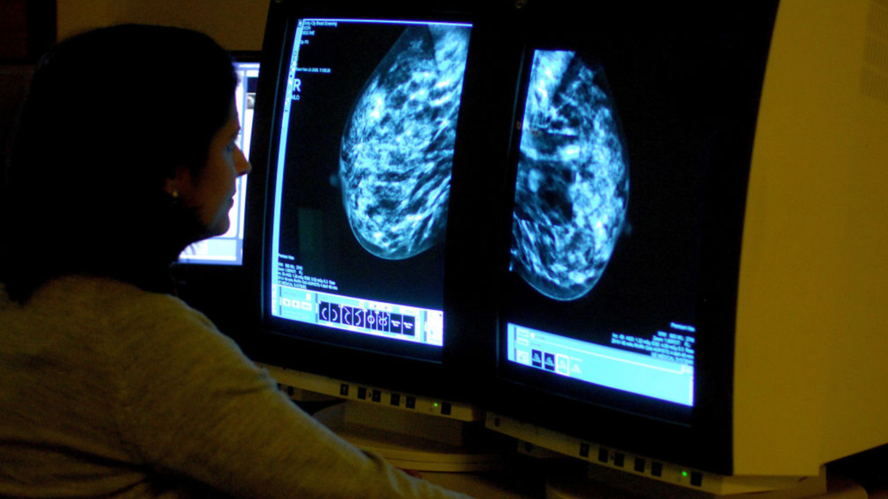 Targeted drug shrinks tumors in 3 out of 4 patients with advanced breast cancer — Wesley Chapel Schools news